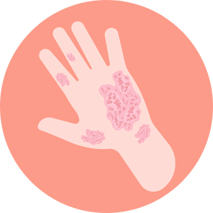 Articulaciones inflamadas y rígidas (en casos de artritis psoriásica)