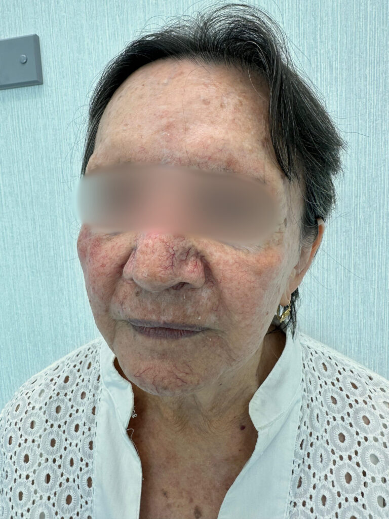 Cirugía Mohs Cáncer Piel Panamá
