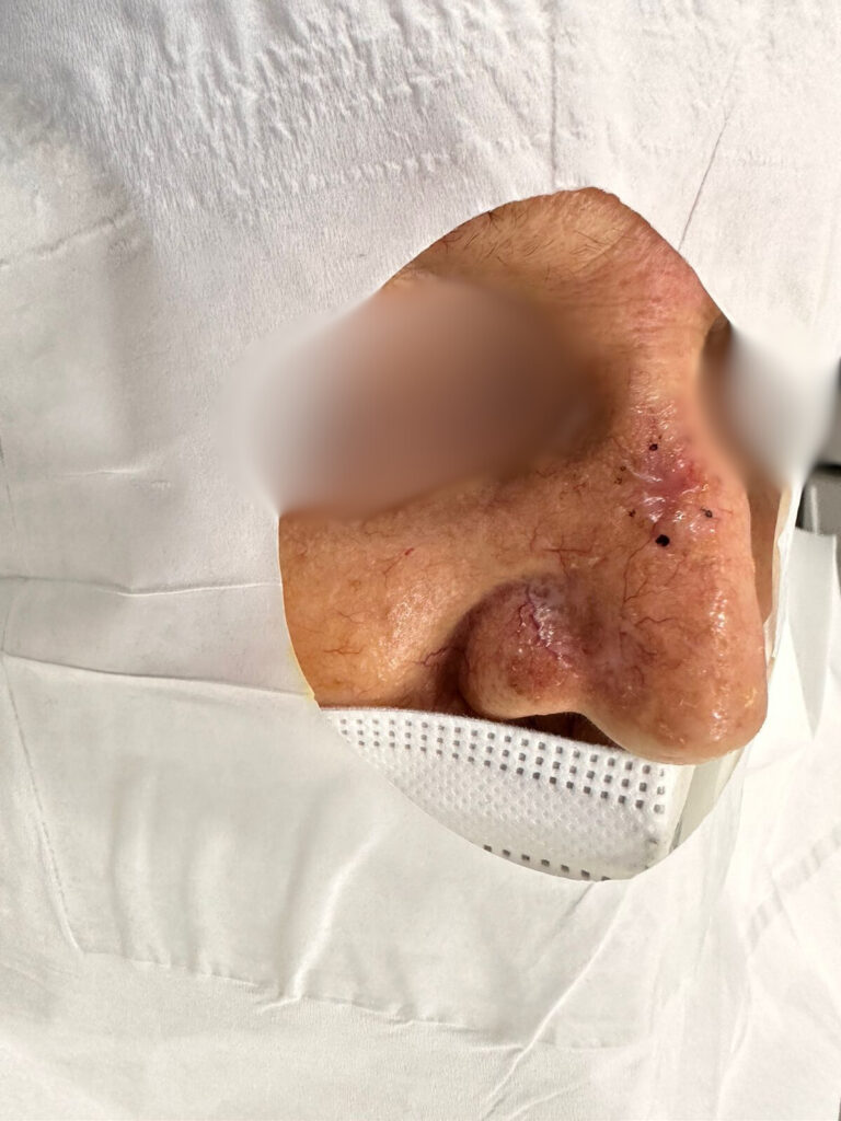 Cirugía de Mohs para Cáncer de Piel en Panamá