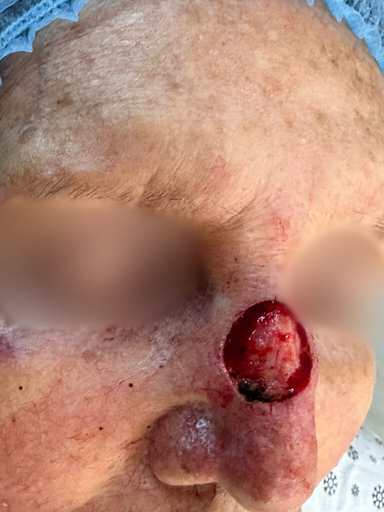 Cirugía de Mohs para Cáncer de Piel Panamá