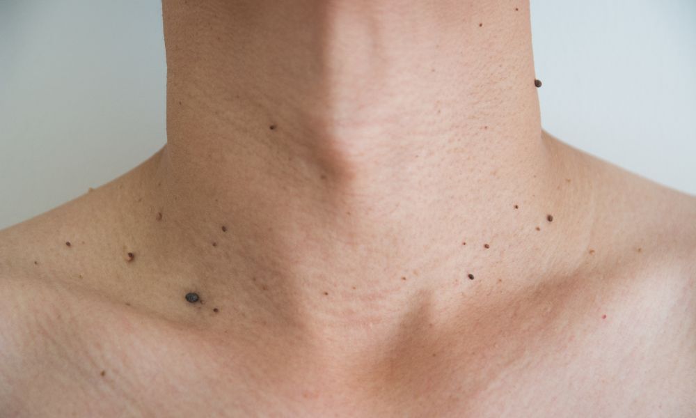 Cuidado de Lunares, Hemangiomas y Lesiones Cutáneas Infantiles