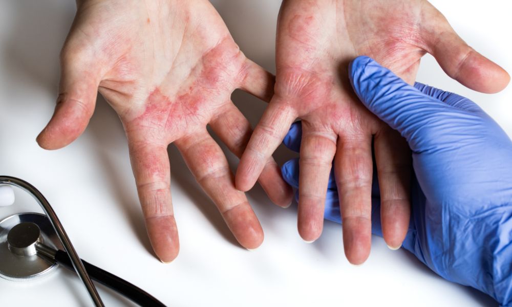 Dermatitis por contacto