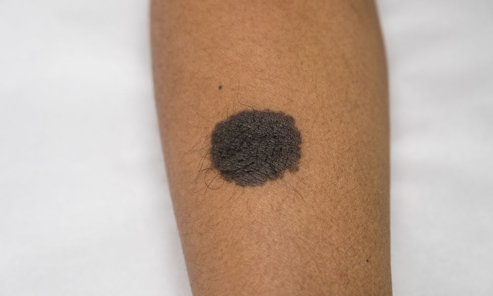 Destrucción de Queratosis Seborreicas