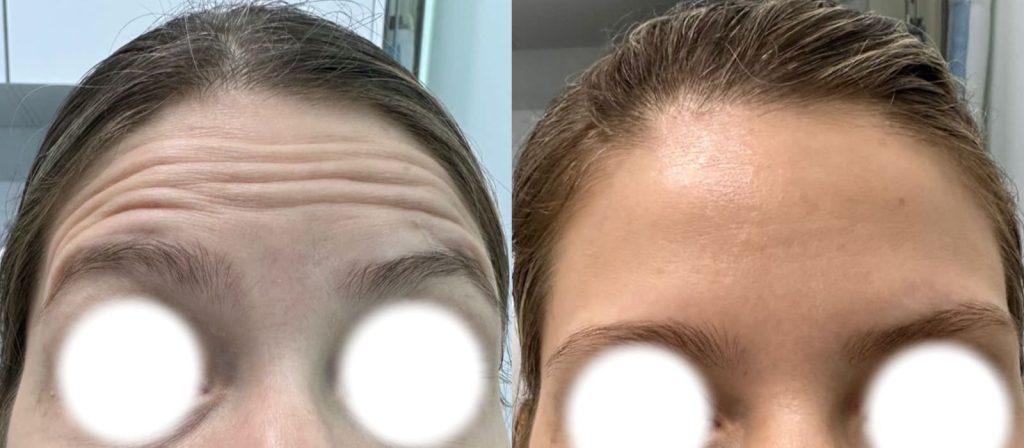 Duración Efecto del Botox