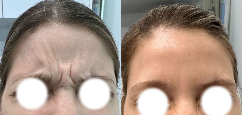 Duración del Efecto del Botox