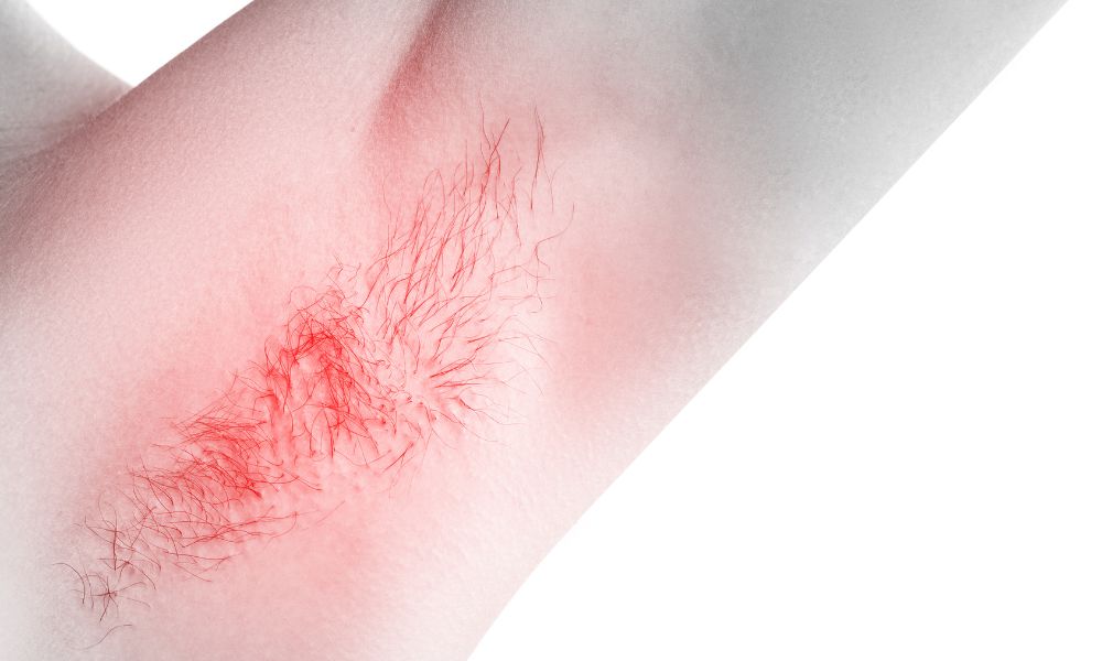 Hidradenitis supurativa