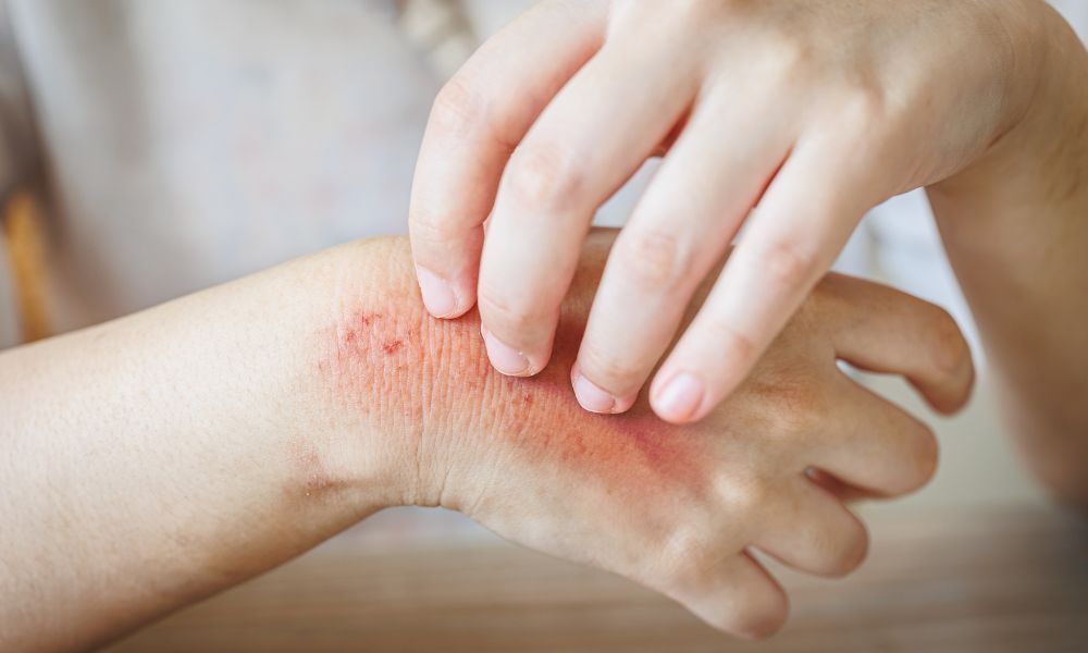 Infecciones bacterianas cutáneas