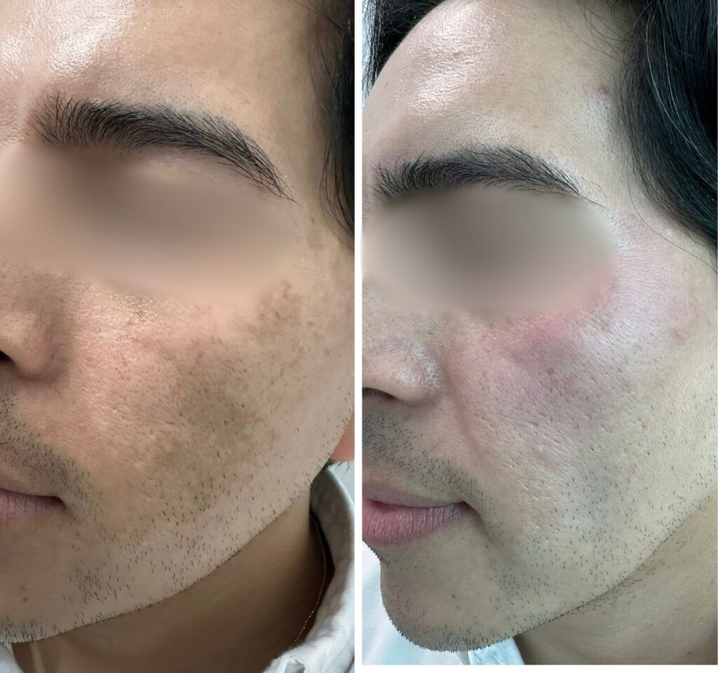Melasma