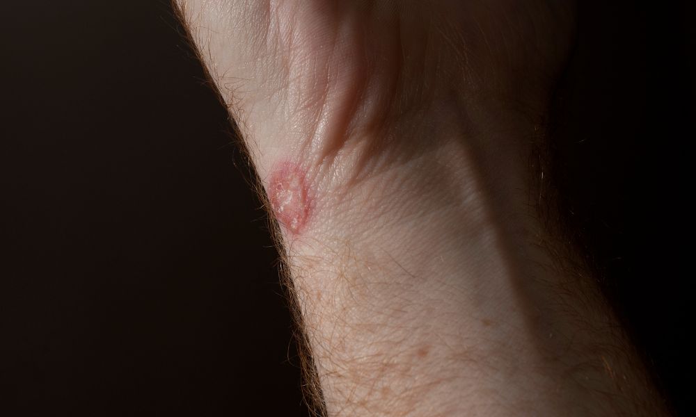 Micosis superficiales y profundas