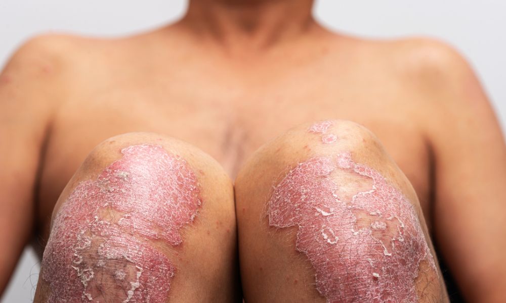Opciones de Tratamiento para la Psoriasis en DERMEC Panamá