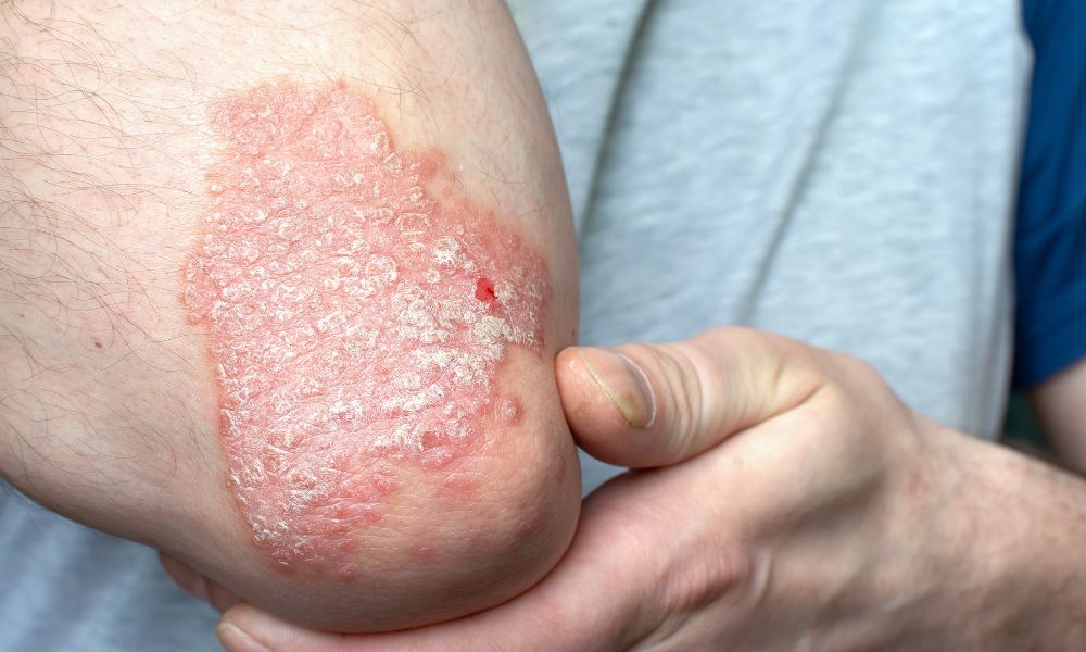 Opciones de Tratamiento para la Psoriasis en DERMEC Panamá