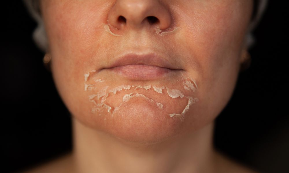 Peeling enzimático