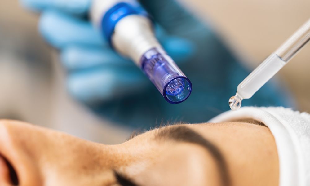 Peelings Químicos y Microneedling