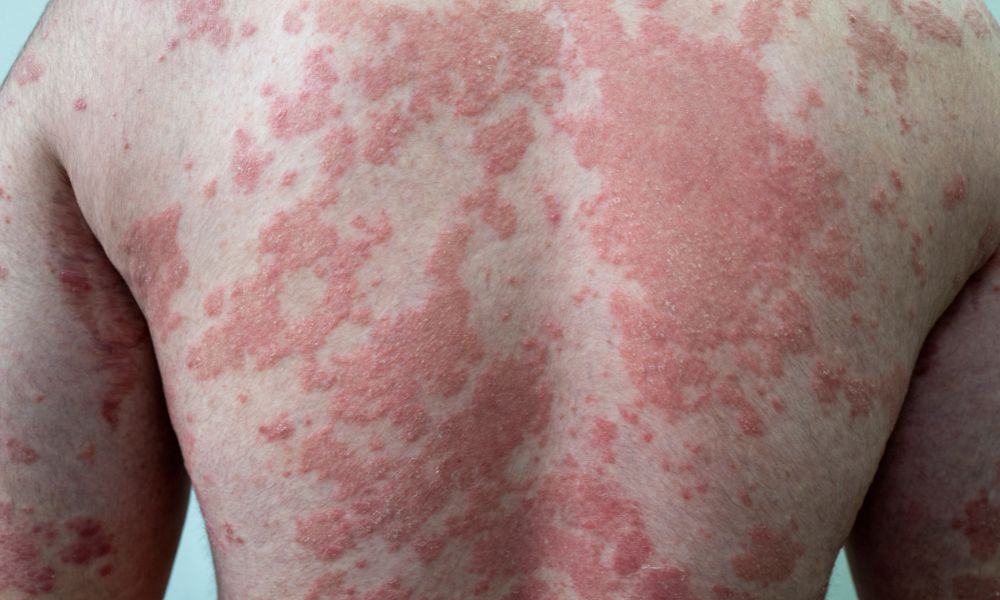 Psoriasis en placas