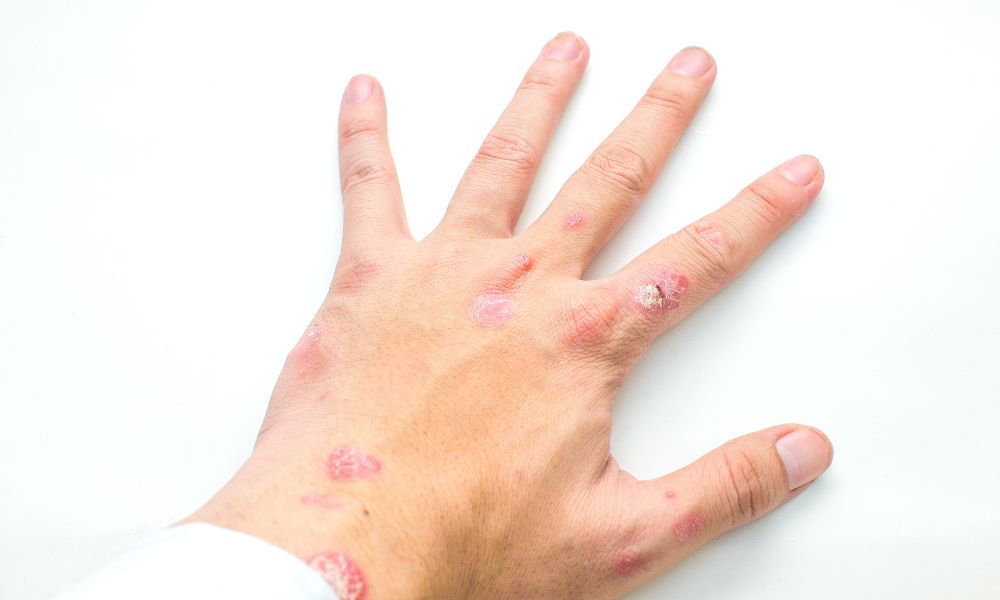 Psoriasis eritrodérmica