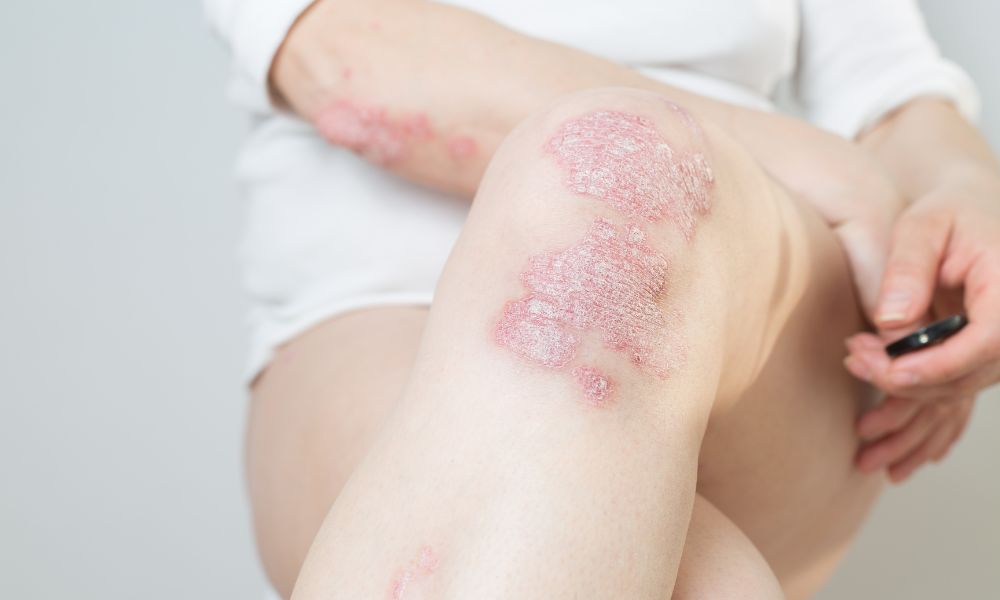 Psoriasis guttata