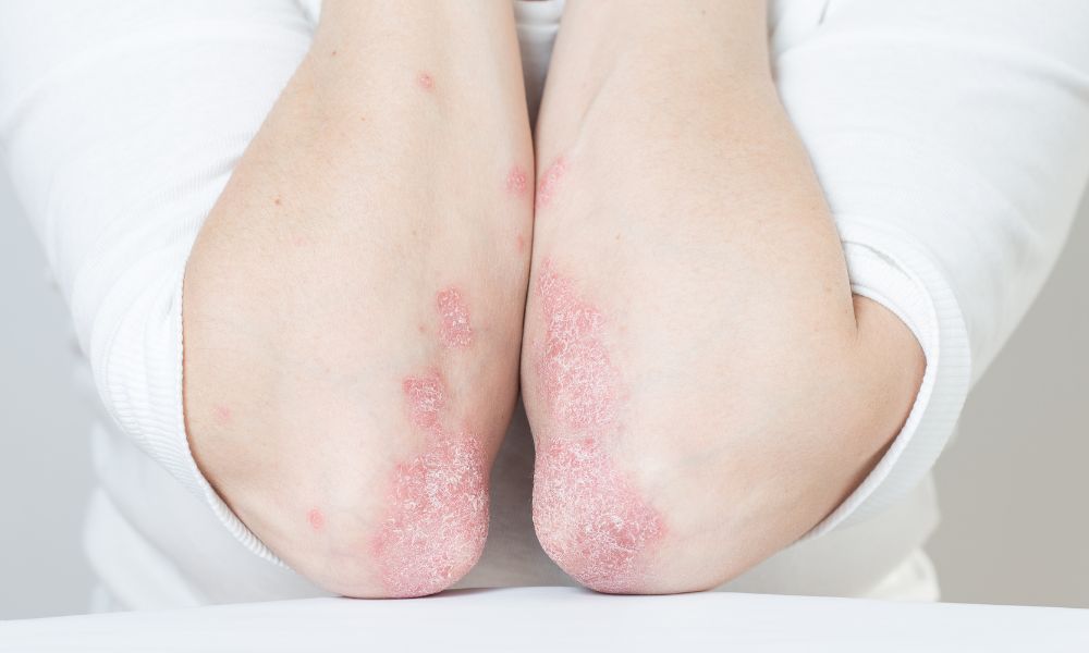Psoriasis inversa