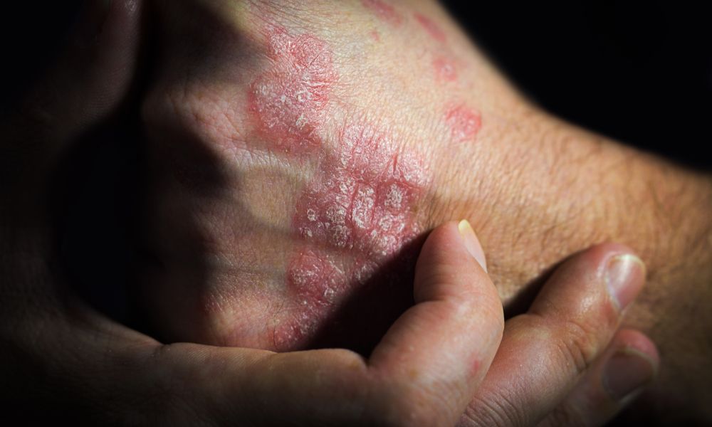 Psoriasis pustulosa