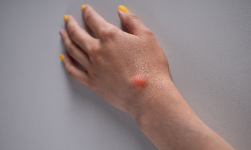 Remoción de Lipoma