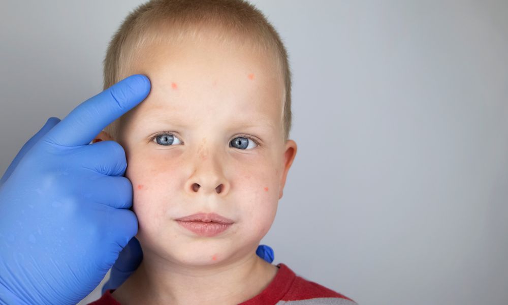 Servicios Especializados de Dermatología Pediátrica en Panamá