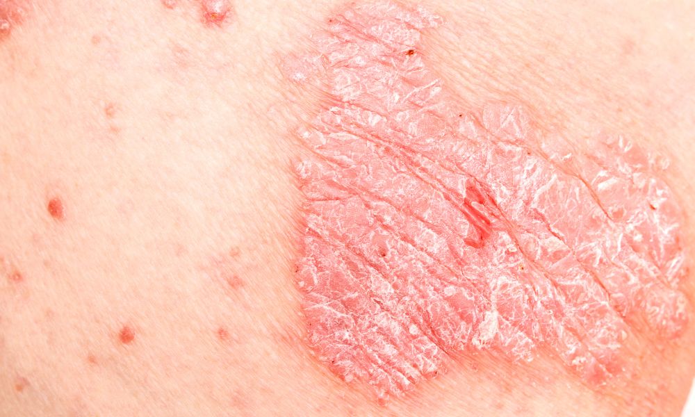 Síntomas comunes de la Psoriasis
