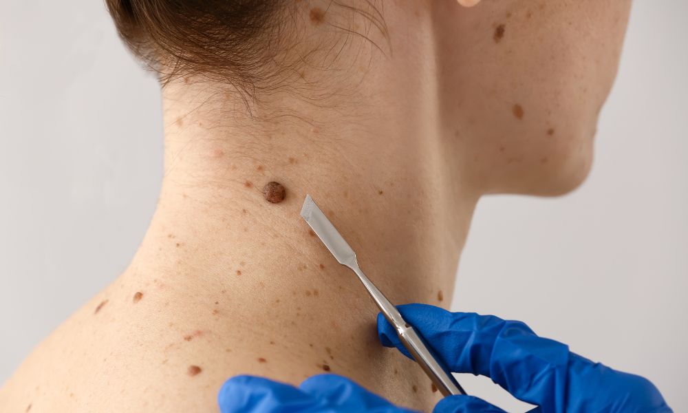 Tratamiento de Cáncer de Piel