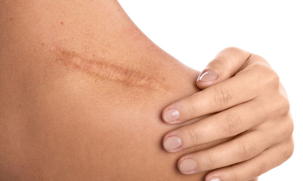 Tratamientos para Manchas y Cicatrices