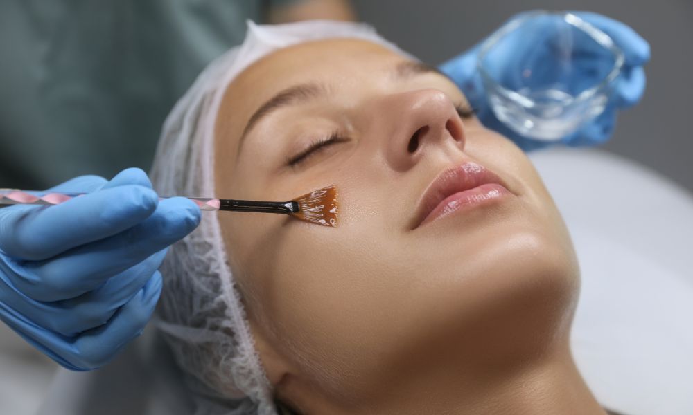 peeling procedimiento dermatológico
