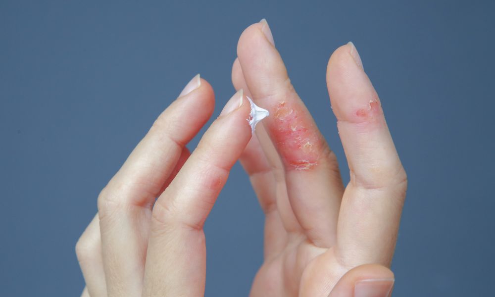 Opciones de Tratamiento para el Eccema en DERMEC