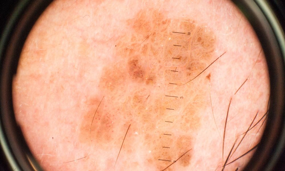 Proceso de la Biopsia de Piel en DERMEC