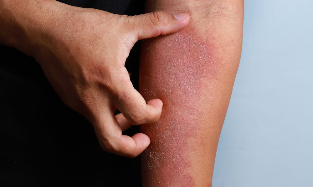 Tratamiento para Eccema DERMEC