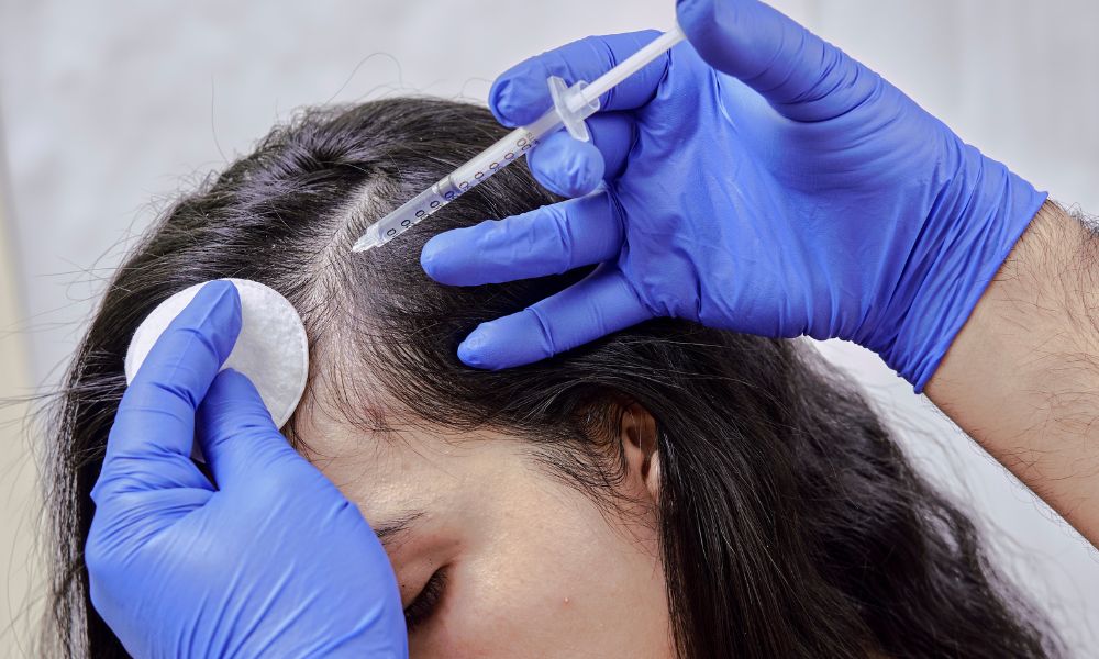 Beneficios de la Mesoterapia Capilar