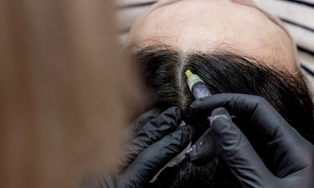 Por qué Elegir DERMEC para tu Tratamiento de Mesoterapia Capilar