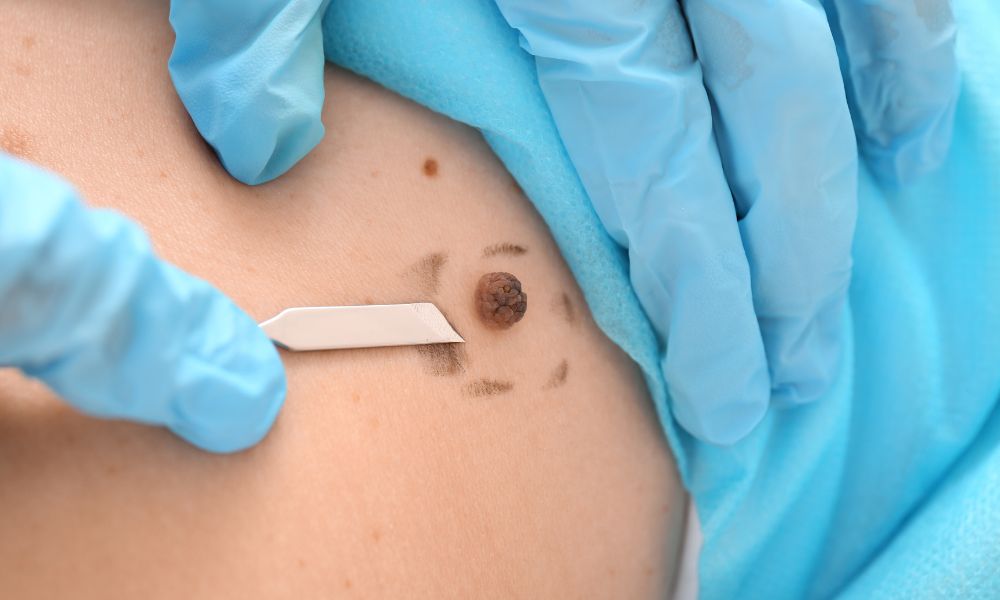 Procedimiento de Revisión de Lunares en DERMEC