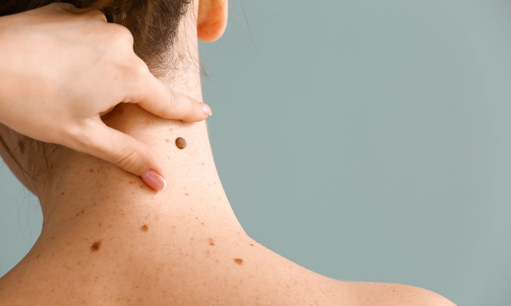 Procedimiento de Revisión de Lunares en DERMEC