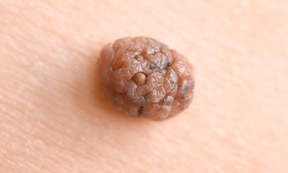 Razones para Realizar una Revisión de Lunares