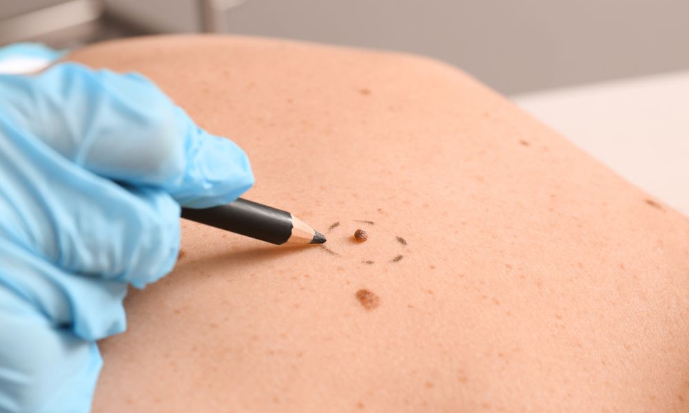 Ventajas de Elegir DERMEC para Revisión de Lunares en Panamá
