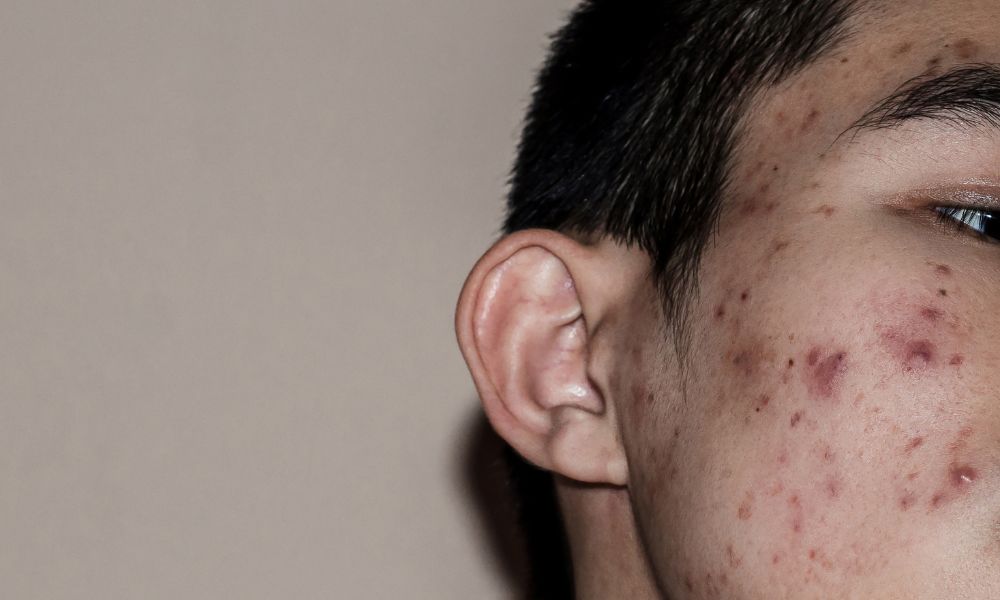 Exfoliación química profunda