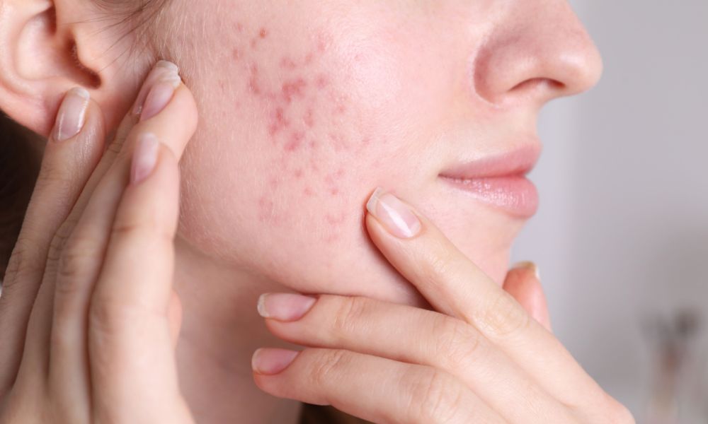 Por qué las cicatrices de acné son un problema