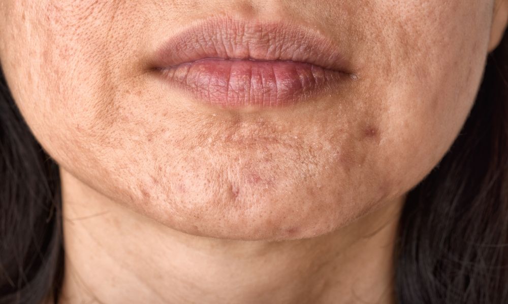 Rellenos concentrados