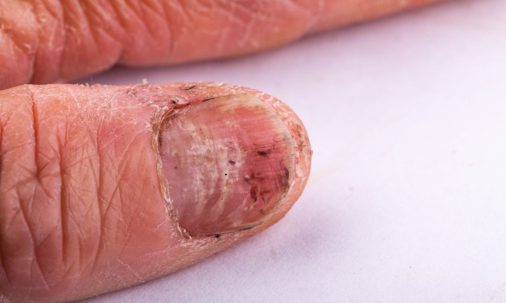 Tratamiento Onicomicosis con Tratamiento Láser