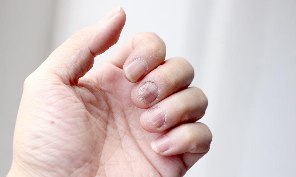 Ventajas Exclusivas del Tratamiento Onicomicosis Panamá en DERMEC