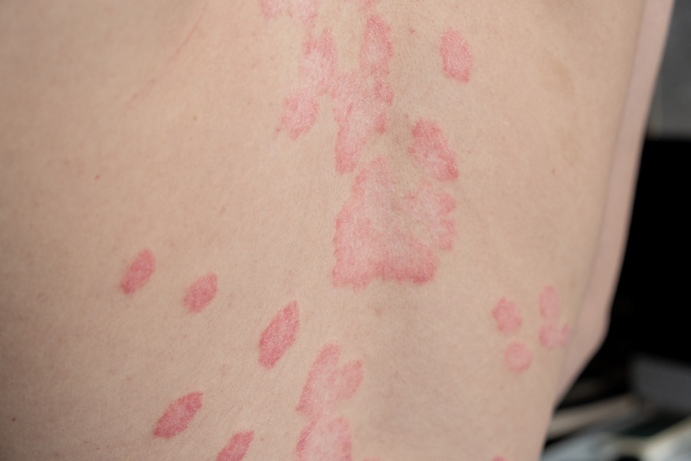 Controla la dermatitis irritativa alivio rápido para piel sensible