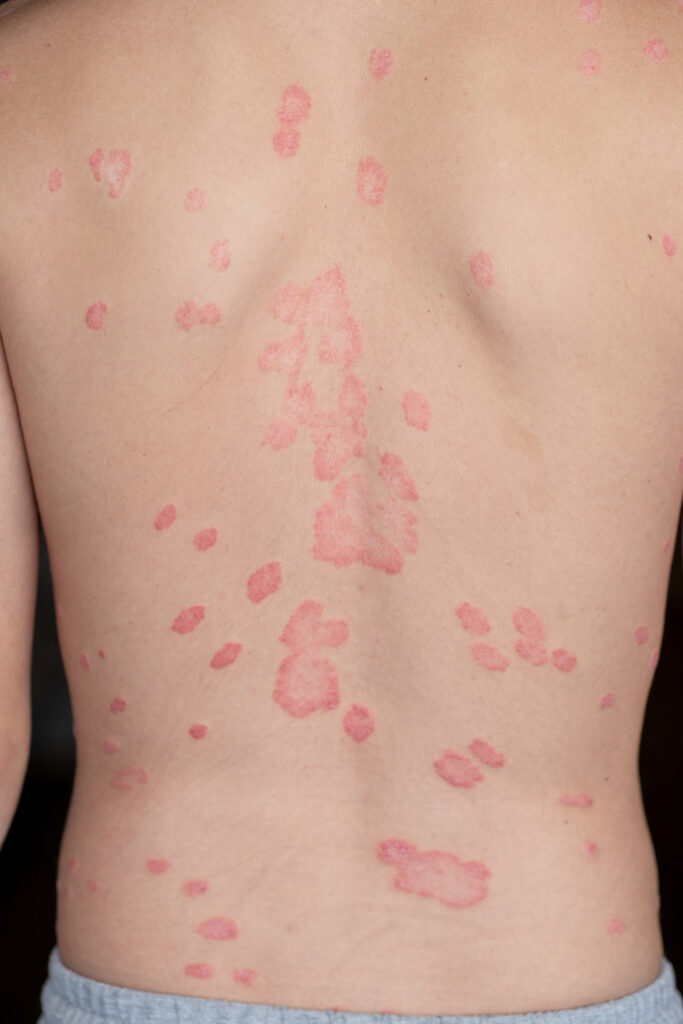 Manejo seguro de dermatitis causada por cosméticos y pacientes atópicos