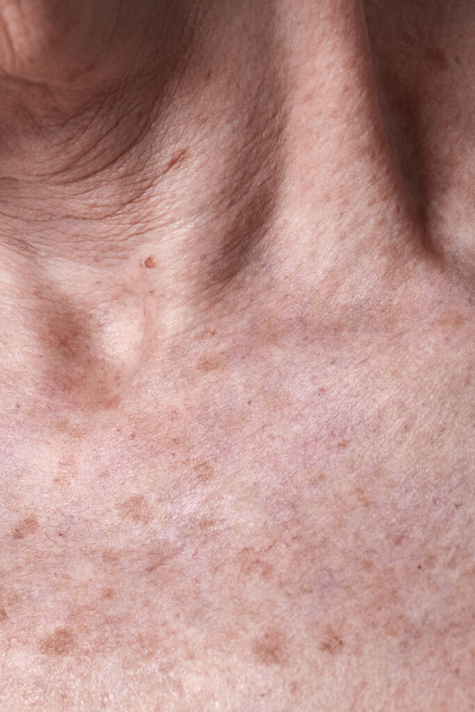 Beneficios del tratamiento dermatomiositis en DERMEC