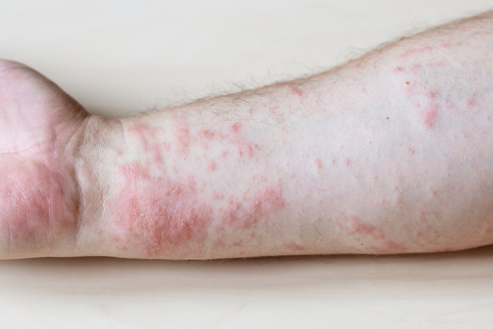 En qué consiste el tratamiento dermatomiositis