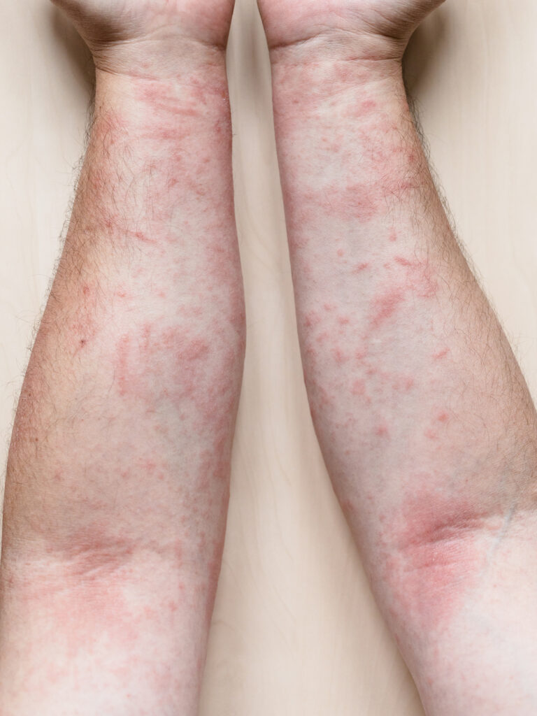 Por qué elegir DERMEC para tu tratamiento de dermatomiositis