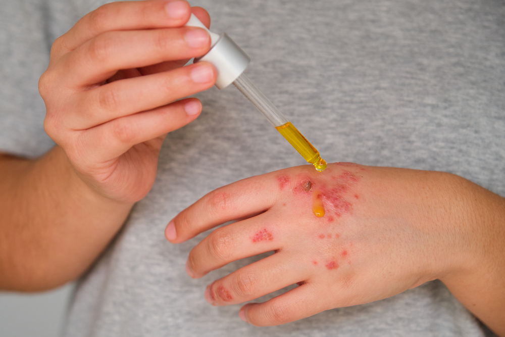 Preguntas frecuentes sobre el tratamiento dermatomiositis