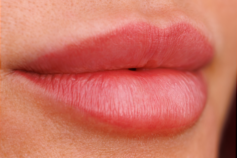 Un Enfoque Experto El Método de DERMEC en Aumento de Labios