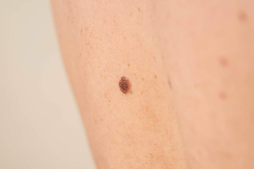 Todo sobre el Curetaje para Queratosis Seborreica en Panamá